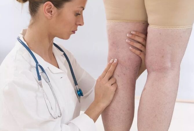 Varices