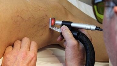 Tratamento con láser de varices